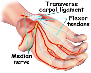 Drawing of the hand palm facing up with inflamed nerves traveling through the carpal tunnel.