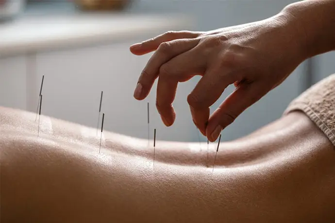 acupuncture to lower back